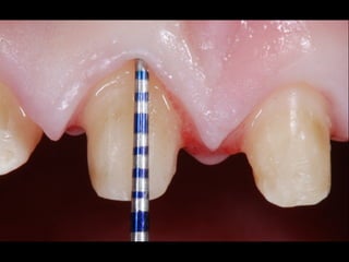 IOS Technologies FastScan 
! 
!!! 
System 
type 
: 
Chairside 
digital 
impression 
Architecture 
: 
Open 
Powder 
: 
??? 
Lab 
Equipment 
: 
3Shape, 
Dental 
Wings, 
Dent 
CAD 
Case 
Delivery 
: 
Doctor 
> 
Laboratory 
Web 
interface, 
E-­‐mail, 
FTP 
Case 
Type 
: 
Scan 
Only 
Materials 
: 
3rd 
party 
Zirconia, 
Wax, 
e.Max 
CAD, 
Chrome-­‐cobalt 
Special 
Features 
: 
 
