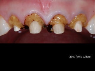 Densys3D 
! 
! 
! 
System 
type 
: 
Chairside 
digital 
impression 
Architecture 
: 
Open 
Powder 
: 
??? 
Lab 
Equipment 
: 
3Shape, 
Dental 
Wings, 
Dent 
CAD 
Case 
Delivery 
: 
Doctor 
(Margin 
Marking) 
> 
Laboratory 
Web 
interface 
Case 
Type 
: 
Scan 
Only 
Materials 
: 
3rd 
party 
Zirconia, 
Wax, 
e.Max 
CAD, 
Chrome-­‐cobalt 
Special 
Features 
: 
 
