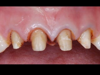 D4D Technologies – E4D 
! 
! 
! 
System 
type 
: 
Chairside 
CAD/CAM 
Architecture 
: 
Closed* 
Powder 
: 
Op)onal 
Lab 
Equipment 
: 
Labworks 
– 
Scanner/Mill, 
E4D 
Studio 
Case 
Delivery 
: 
SkyNetwork, 
LAN/Ethernet 
Case 
Type 
: 
Scan 
Only, 
or 
Scan 
and 
Designed 
Materials 
: 
Empress 
CAD, 
e.Max 
CAD, 
Paradigm 
C, 
Paradign 
Z100, 
Empress 
Zircad, 
BOB 
(acrylic), 
Telocad 
(provisional) 
Special 
Features 
: 
Mul)ple 
unit 
edi)ng, 
rubber 
tooth 
(sophis)cated, 
Milling 
independent 
on 
IOD 
status, 
SOS 
 