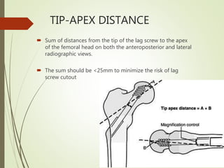 fracture It femur | PPTX