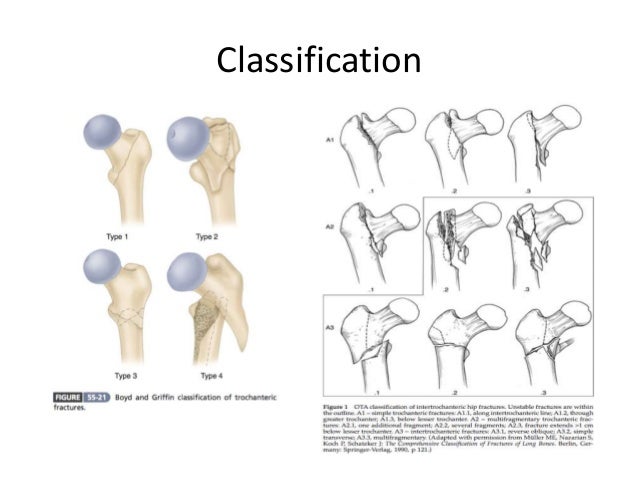 intertrochanteric fracture management intertrochanteric fracture