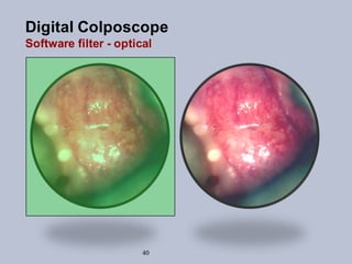 40
Digital Colposcope
Software filter - optical
 