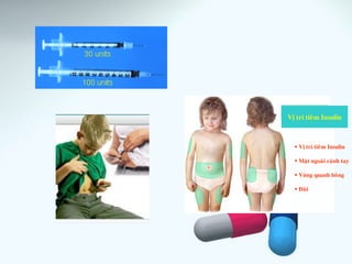 Vò trí tieâm Insulin
 Maët ngoaøi caùnh tay
 Vuøng quanh hoâng
 Ñuøi
Vò trí tieâm Insulin
 