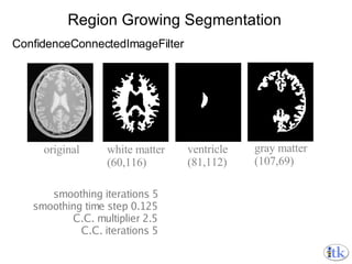 Region Growing Segmentation ConfidenceConnectedImageFilter smoothing iterations 5 smoothing time step 0.125 C.C. multiplier 2.5 C.C. iterations 5 white matter (60,116) original ventricle (81,112) gray matter (107,69) 