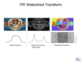 ITK Watershed Transform Image (filtered) Feature Extraction “ Edge Map” Watershed Transform Watershed Depth 