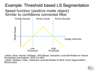 Example: Threshold based LS Segmentation Speed function (positive inside object) Similar to confidence connected filter Points Inside Points Outside Points Outside Low Threshold High Threshold Image Intensity Model Speed Lefohn, Kniss, Hansen, Whitaker, “GPU-Based, Interactive, Level-Set Models for Volume Visualization and Analysis”, IEEE Vis 2003 Lefohn, Whitaker, Cates, “Interactive Level-Set Models for Brain Tumor Segmentation”, MICCAI 2003 