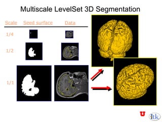 Multiscale LevelSet 3D Segmentation Seed surface Data Scale 1/4 1/2 1/1 