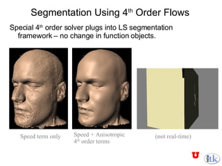 Segmentation Using 4 th  Order Flows Special 4 th  order solver plugs into LS segmentation  framework – no change in function objects. Speed term only Speed + Anisotropic 4 th  order terms (not real-time) 