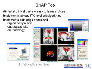 SNAP Tool Aimed at clinical users – easy to learn and use Implements various ITK level set algorithms Implements both edge-based and  region competition  geodesic snake  methodology InsightApplications/Snap 