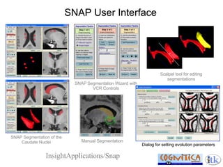 SNAP User Interface Dialog for setting evolution parameters Scalpel tool for editing segmentations Manual Segmentation InsightApplications/Snap SNAP Segmentation of the Caudate Nuclei SNAP Segmentation Wizard with VCR Controls 