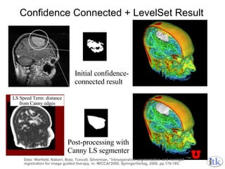 Confidence Connected + LevelSet Result Initial confidence- connected result Post-processing with  Canny LS segmenter LS Speed Term: distance from Canny edges Data: Warfield, Nabavi, Butz, Tuncali, Silverman, “Intraoperative segmentation and nonrigid  registration for image guided therapy, in: MICCAI'2000, SpringerVerlag, 2000, pp.176-185. 