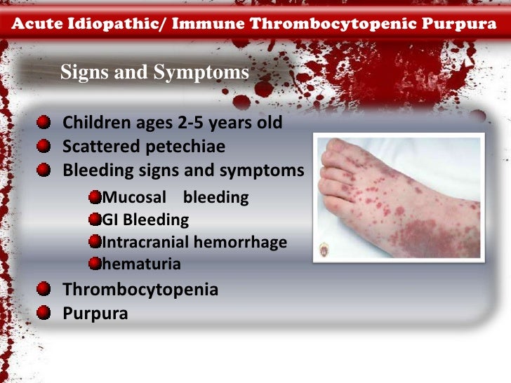 immune thrombocytopenic purpura