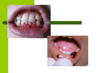 ITP (IDIOPATIK THROMBOSITOPENIK PURPURA)