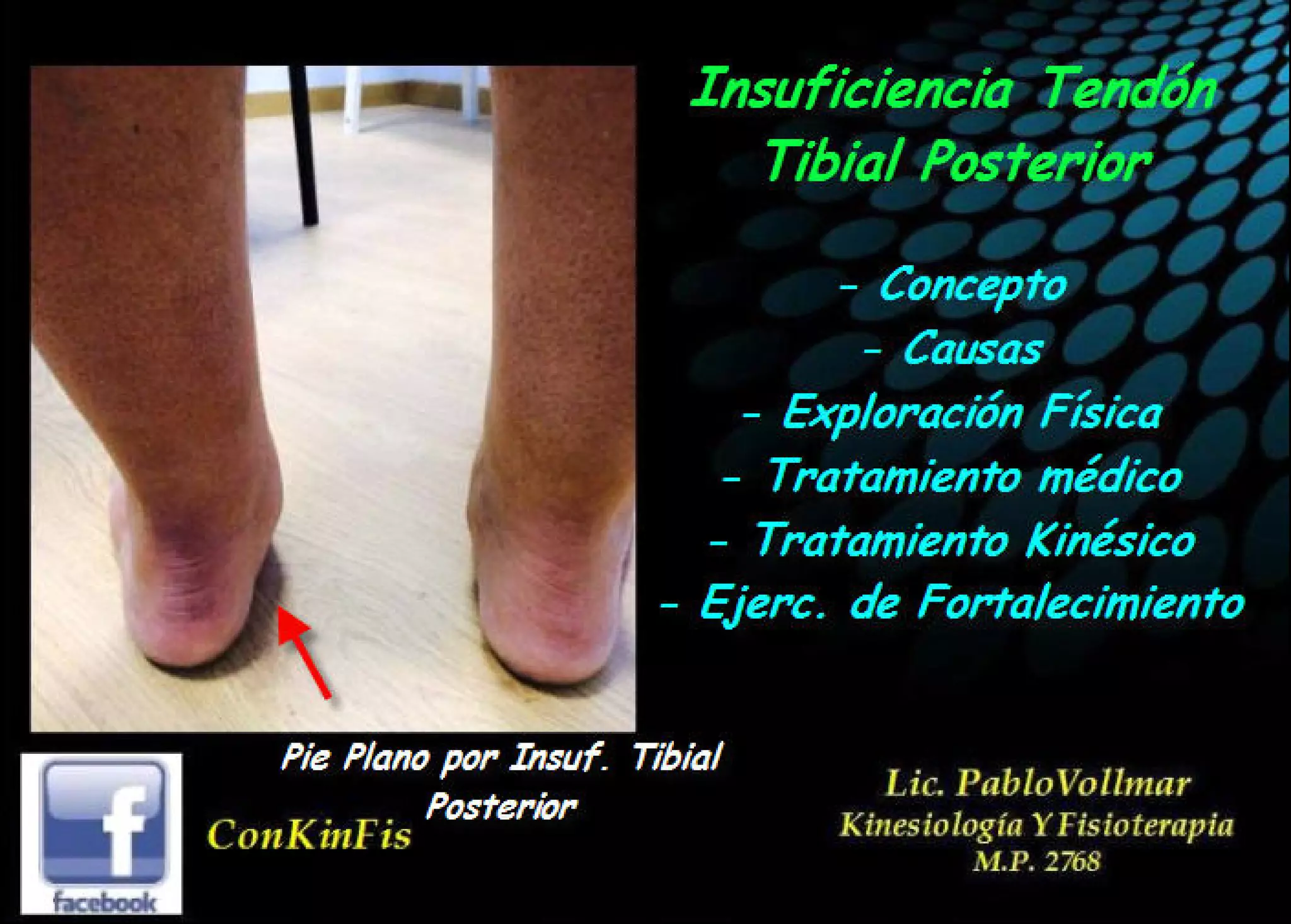 Insuficiencia Tibial Posterior