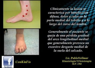 Insuficiencia Tibial Posterior