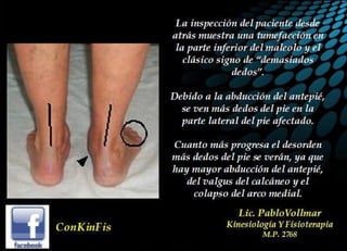 Insuficiencia Tibial Posterior