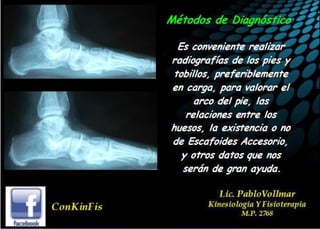 Insuficiencia Tibial Posterior
