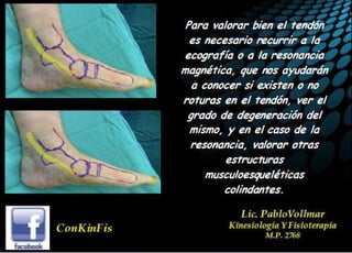 Insuficiencia Tibial Posterior