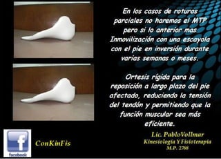 Insuficiencia Tibial Posterior