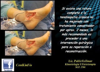 Insuficiencia Tibial Posterior