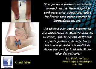 Insuficiencia Tibial Posterior