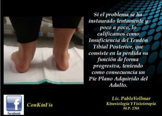 Insuficiencia Tibial Posterior