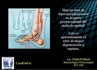 Insuficiencia Tibial Posterior