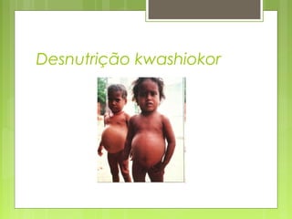Desnutrição kwashiokor
 