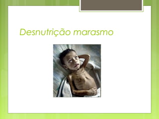 Desnutrição marasmo
 