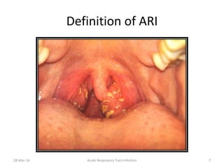 Definition of ARI
28-Mar-16 Acute Respiratory Tract Infection 7
 