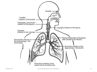 28-Mar-16 Acute Respiratory Tract Infection 9
 