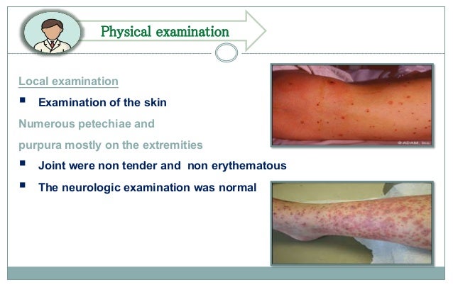 Idiopathic Thrombocytopenic Purpura