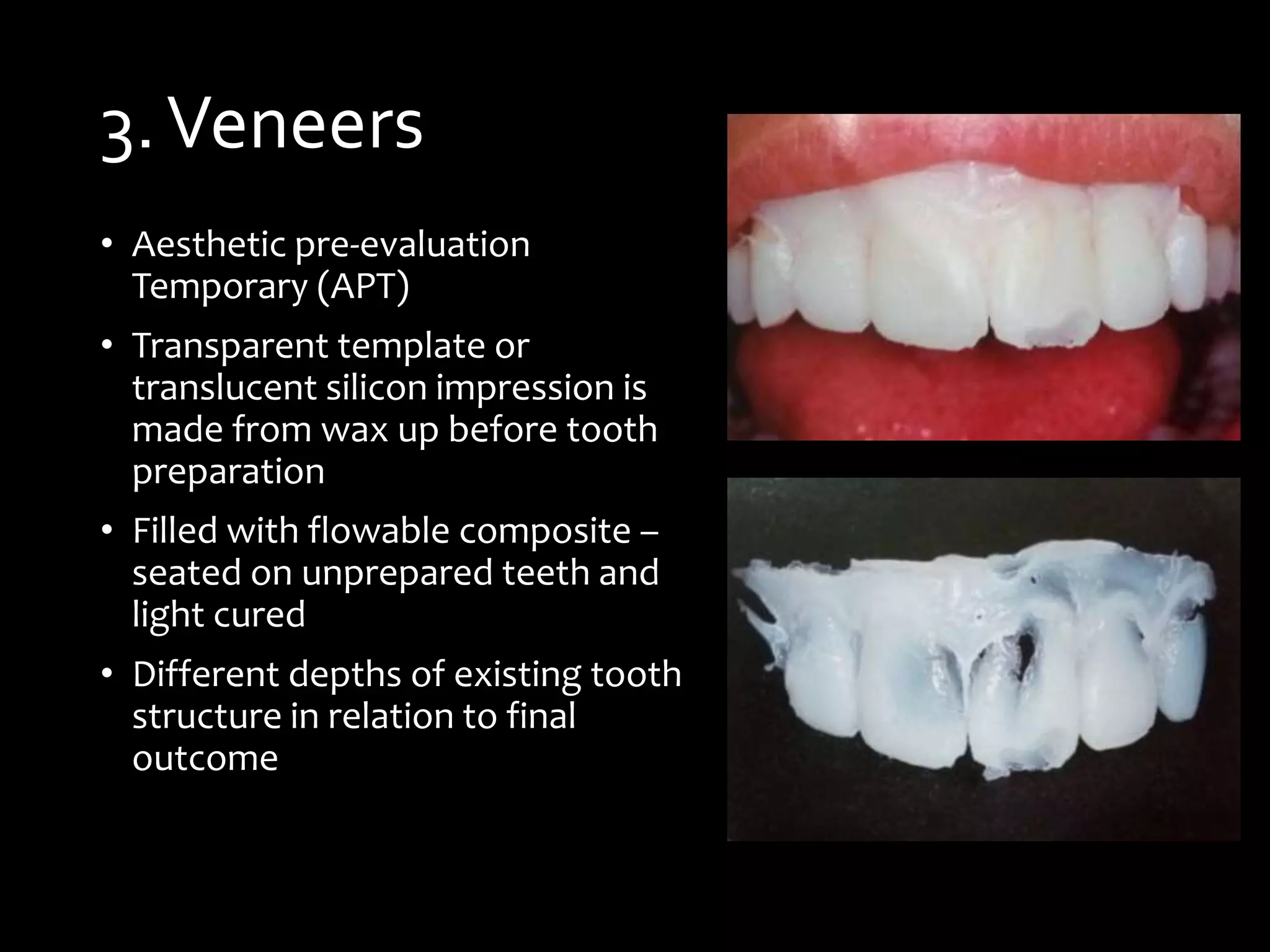 3.Veneers
• Aesthetic pre-evaluation
Temporary (APT)
• Transparent template or
translucent silicon impression is
made from wax up before tooth
preparation
• Filled with flowable composite –
seated on unprepared teeth and
light cured
• Different depths of existing tooth
structure in relation to final
outcome
 
