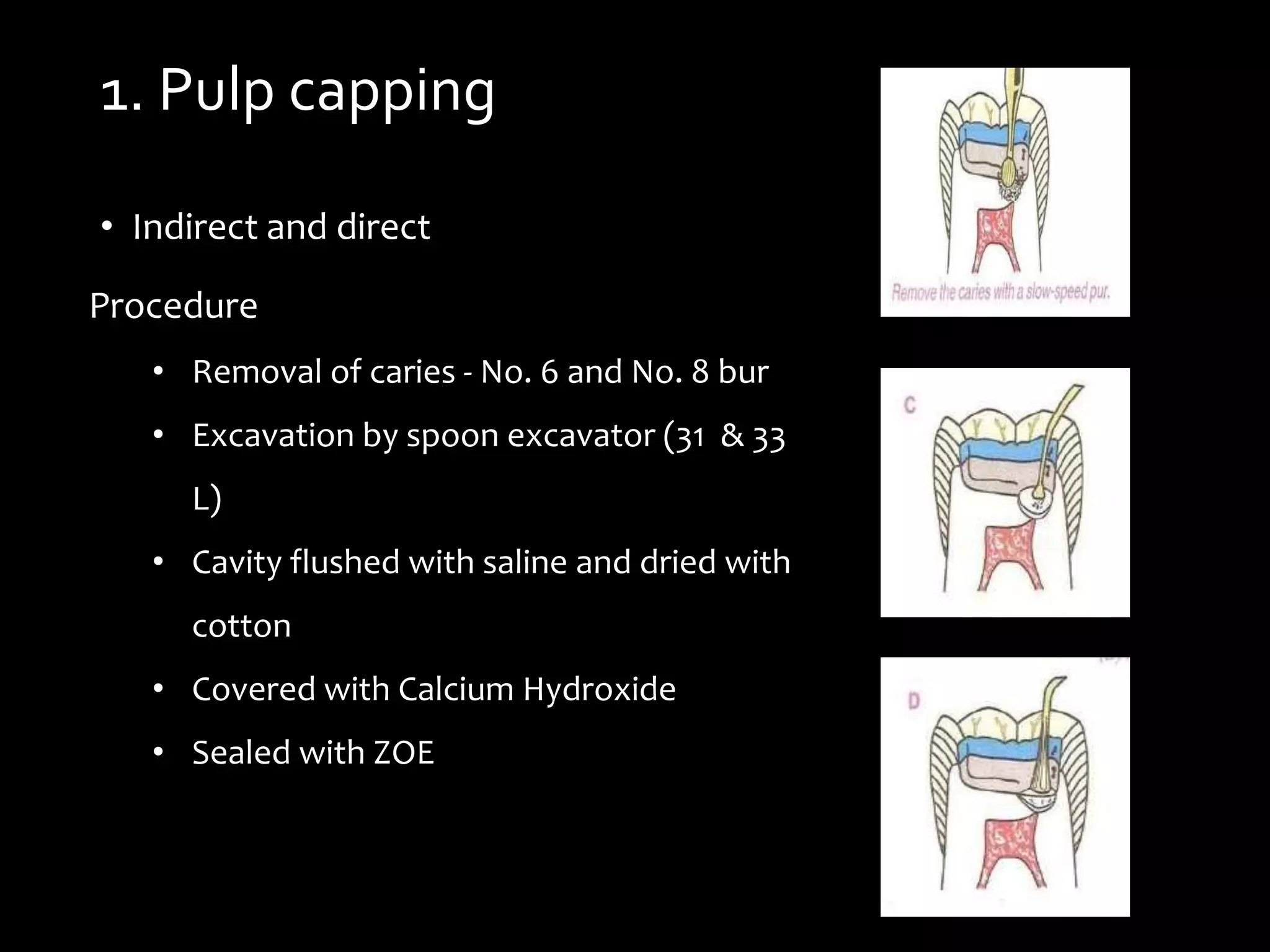 1. Pulp capping
• Indirect and direct
Procedure
• Removal of caries - No. 6 and No. 8 bur
• Excavation by spoon excavator (31 & 33
L)
• Cavity flushed with saline and dried with
cotton
• Covered with Calcium Hydroxide
• Sealed with ZOE
 
