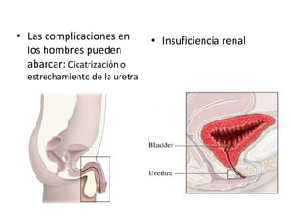 Las complicaciones en los hombres pueden abarcar:  Cicatrización o estrechamiento de la uretra  Insuficiencia renal 