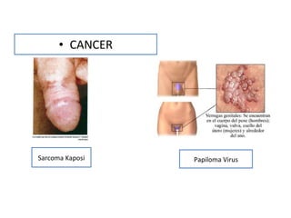 CANCER Papiloma Virus Sarcoma Kaposi 