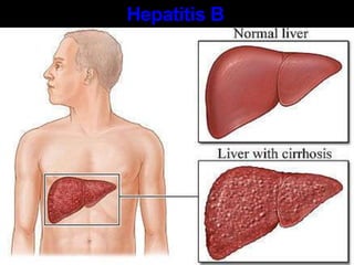 SidaSíntomas   Los síntomas del SIDA son principalmente el resultado de infecciones que normalmente no se desarrollan en personas con un sistema inmunológico sano. Estas se llaman "infecciones oportunistas".