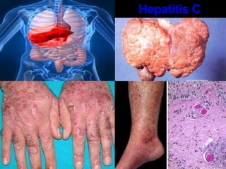En el momento de nacer, una madre infectada puede transmitirle el virus al bebé en el momento del parto o inmediatamente después de éste.