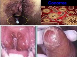 Pérdida del apetito