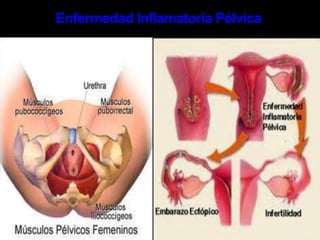 Puedes tener sífilis sin tener ningún síntoma y aun así puedes transmitirla a otros. Los síntomas tempranos son muy similares a los de muchas otras enfermedades. SífilisLa sífilis tiene 4 etapas de síntomas: Sífilis PrimariaChancro sifilítico: después de 10 días a 6 semanas del contagio, se presenta una ampolla no dolorosa que rápidamente se ulcera. En el varón heterosexual suele localizarse en el pene, en el homosexual en el canal anal o recto, dentro de la boca o en los genitales externos, mientras que en la mujer, las áreas más frecuentes son: cuello uterino y los labios genitales mayores o menores. 