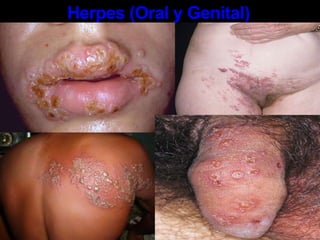 La primera aparición de síntomas durante la primera infección de herpes genital se llama "herpes" primario. Al principio se puede tener una sensación de hormigueo o picor en el área genital. Puede haber secreciones vaginales, sensación de presión en el abdomen y dolor en las nalgas, piernas y el área de la ingle. Herpes En el área cercana al lugar por donde el virus entró al cuerpo aparecen pequeñas protuberancias rojas - en los labios vaginales, el clítoris, la vagina, la vulva, el cuello uterino, el ano, los muslos o las nalgas. Estas protuberancias se convierten en ampollas o llagas abiertas. Entre 24 y 72 horas después de que aparecen las pequeñas ampollas, éstas pueden reventarse y dejar lastimaduras dolorosas que pueden infectarse. Herpes Otros síntomas del herpes primario pueden incluir:Picor