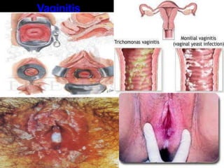 Crecimiento del hígado y bazo (Hepatoesplenomegalia) 