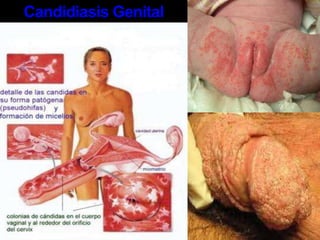 La gonorrea también puede ser pasada a un ojo con la mano o con otra parte del cuerpo humedecida con líquidos infectados. Si una mujer embarazada tiene gonorrea, puede pasar el germen a los ojos de su bebé durante el parto, lo cual puede causar una infección de ojos seria.GonorreaSíntomas  Es posible tener gonorrea sin tener ningún síntoma. Cuando sí se tienen síntomas, éstos pueden tardar de 1 a 30 días en desarrollarse después de producirse la infección (el promedio es de 3 a 5 días). Con síntomas o sin síntomas, igual se les puede pasar el germen a otras personas. Los síntomas de la gonorrea incluyen:Secreciones anormales de la vagina