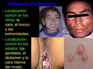 Eritromicinas, 500 mg vía oral, cuatro veces al día por una semana.ChlamydiaCausasEsta enfermedad es causada por la bacteria, Chlamydia Trachomatis. Esta bacteria puede infectar las mucosas del cérvix, del ano, de la uretra y de los ojos. La Chlamydia se propaga de dos maneras por contacto sexual vaginal o contacto sexual anal. Se puede propagar también de una mujer a su feto durante el embarazo o propagarse a su bebé durante el nacimiento.Chlamydia