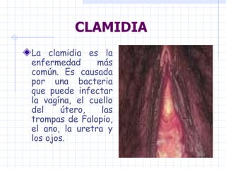 CLAMIDIA
La clamidia es la
enfermedad      más
común. Es causada
por una bacteria
que puede infectar
la vagína, el cuello
del    útero,    las
trompas de Falopio,
el ano, la uretra y
los ojos.
 