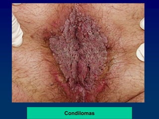 Condilomas
 