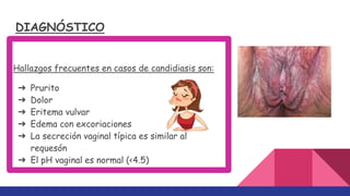 DIAGNÓSTICO
Hallazgos frecuentes en casos de candidiasis son:
➔ Prurito
➔ Dolor
➔ Eritema vulvar
➔ Edema con excoriaciones
➔ La secreción vaginal típica es similar al
requesón
➔ El pH vaginal es normal (<4.5)
 