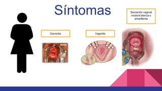 Síntomas
Cervicitis Vaginitis
Secreción vaginal
inodora blanca o
amarillenta
 