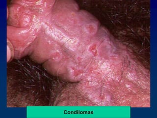 Condilomas
 