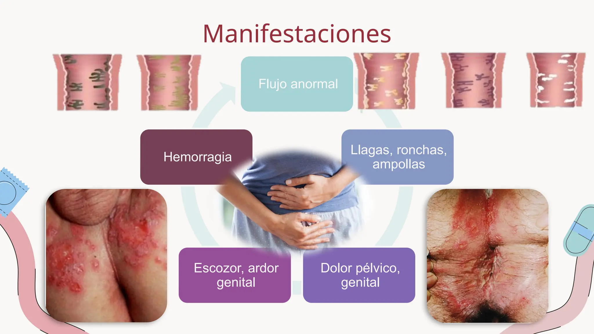 Infecciones de Transmision Sexual...pptx